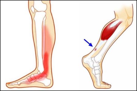 Las tendinopatías de miembro inferior