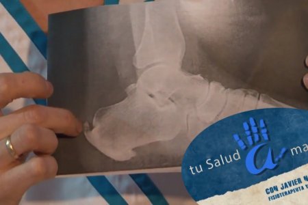 Origen y Prevención de las Calcificaciones