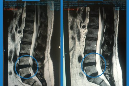 Hernia de disco lumbar con neuralgia ciática izquierda