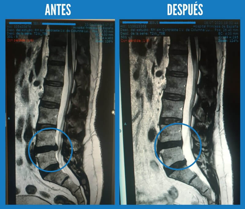 Hernia de disco lumbar con neuralgia ciática izquierda